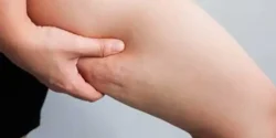 عوارض سلولیت پوست + تشخیص و راههای پیشگیری و درمان