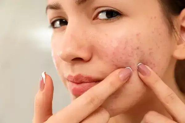 علائم آکنه روزاسه + علت و درمان و راههای پیشگیری از آن