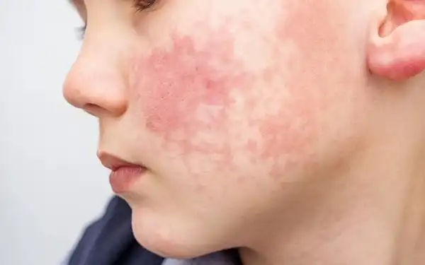 علائم قارچ پوستی + علت و درمان و راههای پیشگیری از آن