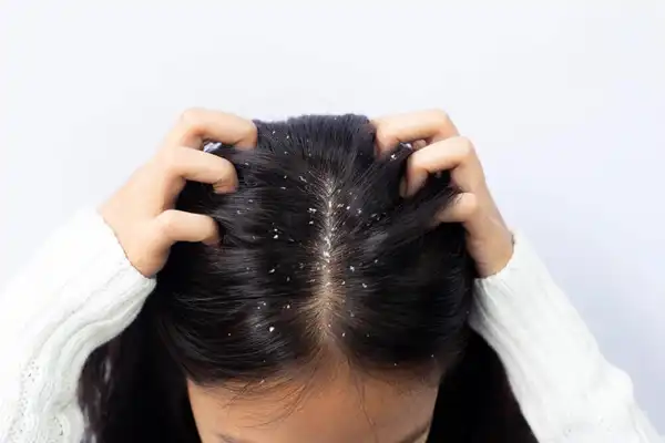 علائم شوره سر + علت و درمان و راههای پیشگیری از آن