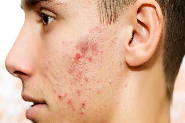 عوارض آکنه + تشخیص و راههای پیشگیری و درمان آن