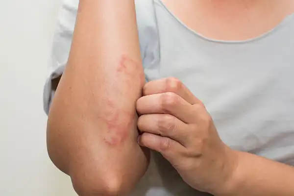 عوارض درماتیت + تشخیص و راههای پیشگیری و درمان آن