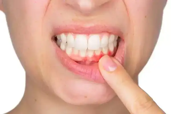 عوارض التهاب دهان + تشخیص و راههای پیشگیری و درمان آن