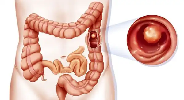 عوارض التهاب روده بزرگ + تشخیص و راههای پیشگیری و درمان آن