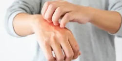 عوارض حساسیت پوستی + تشخیص و راههای پیشگیری و درمان آن