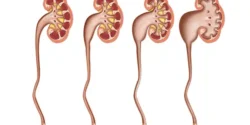 عوارض هیدرونفروز + تشخیص و راههای پیشگیری و درمان آن