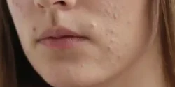 عوارض جوش زیر پوستی + تشخیص و راههای پیشگیری و درمان آن