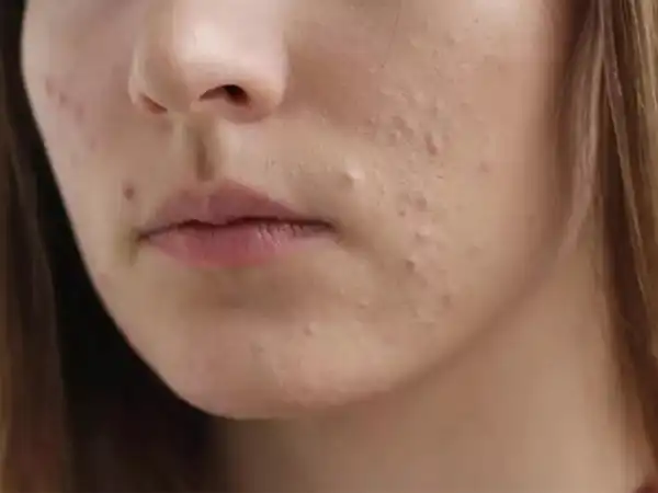 عوارض جوش زیر پوستی + تشخیص و راههای پیشگیری و درمان آن