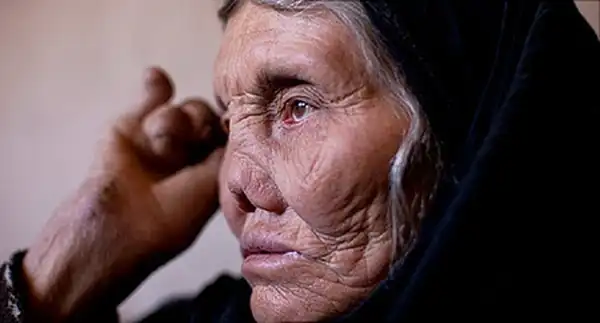 عوارض جذام + تشخیص و راههای پیشگیری و درمان آن