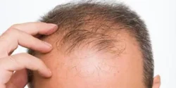 عوارض کچلی + تشخیص و راههای پیشگیری و درمان آن