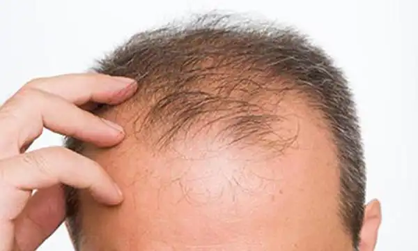 عوارض کچلی + تشخیص و راههای پیشگیری و درمان آن