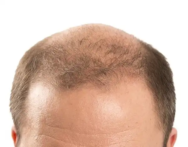 عوارض ریزش مو + تشخیص و راههای پیشگیری و درمان آن