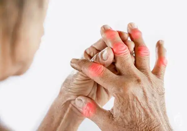 عوارض روماتیسم مفصلی + تشخیص و راههای پیشگیری و درمان آن