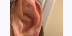 عوارض شکستگی گوش + تشخیص و راههای پیشگیری و درمان آن