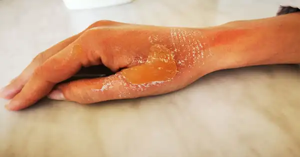 عوارض سوختگی با بخار + تشخیص و راههای پیشگیری و درمان آن