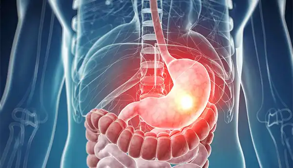 عوارض زخم اثنی عشر + تشخیص و راههای پیشگیری و درمان آن