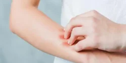عوارض بیماری گال + تشخیص و راههای پیشگیری و درمان آن