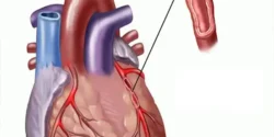 عوارض بیماری عروق کرونر + تشخیص و راههای پیشگیری و درمان آن