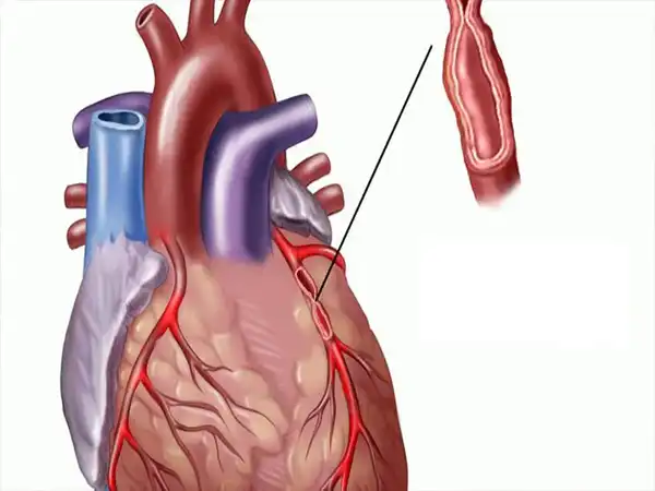 عوارض بیماری عروق کرونر + تشخیص و راههای پیشگیری و درمان آن