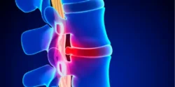 عوارض فتق دیسک کمر + تشخیص و راههای پیشگیری و درمان آن