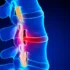 عوارض فتق دیسک کمر + تشخیص و راههای پیشگیری و درمان آن