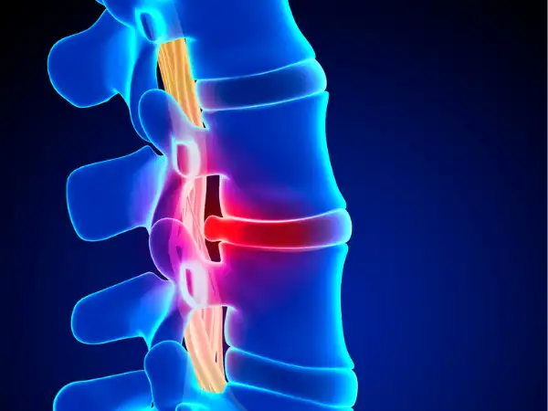 عوارض فتق دیسک کمر + تشخیص و راههای پیشگیری و درمان آن