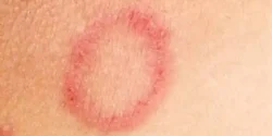 عوارض قارچ پوستی + تشخیص و راههای پیشگیری و درمان آن