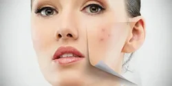 عوارض جای جوش + تشخیص و راههای پیشگیری و درمان آن