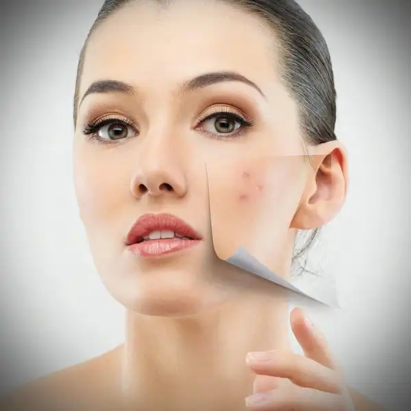 عوارض جای جوش + تشخیص و راههای پیشگیری و درمان آن