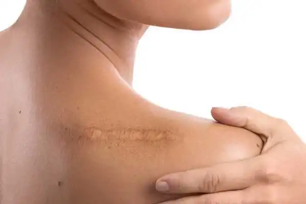 عوارض جای زخم + تشخیص و راههای پیشگیری و درمان آن