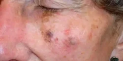 عوارض ملانوما + تشخیص و راههای پیشگیری و درمان آن
