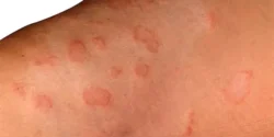 عوارض راش پوستی + تشخیص و راههای پیشگیری و درمان آن