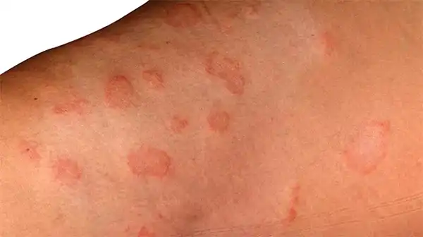 عوارض راش پوستی + تشخیص و راههای پیشگیری و درمان آن