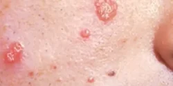 عوارض سالک + تشخیص و راههای پیشگیری و درمان آن