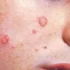 عوارض سالک + تشخیص و راههای پیشگیری و درمان آن