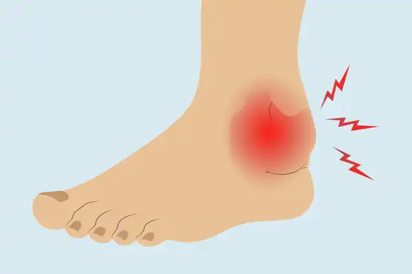 عوارض ورم قوزک پا + تشخیص و راههای پیشگیری و درمان آن