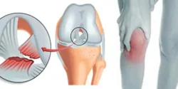 عوارض پارگی مینیسک زانو + تشخیص و راههای پیشگیری و درمان آن