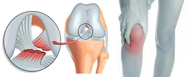 عوارض پارگی مینیسک زانو + تشخیص و راههای پیشگیری و درمان آن
